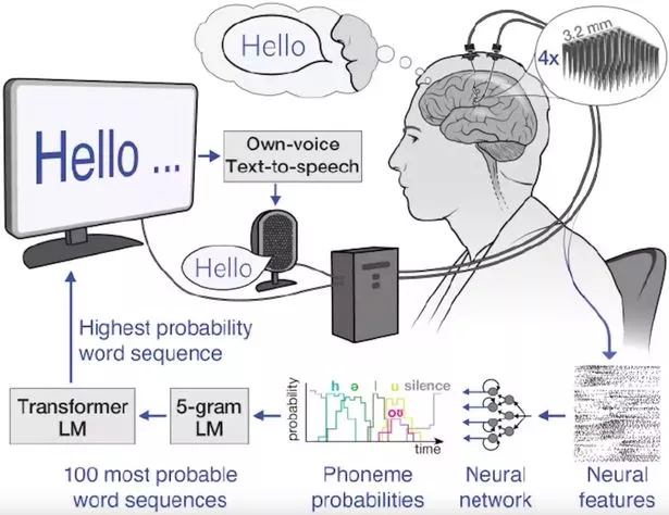 Brain Computer Interface Translates Als Patients Brain Activity Into Spoken Words News Medical Net