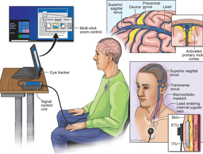 Brain To Brain Technology Boosts Brain Computer Interface Performance Study Demonstrates Medical Xpress